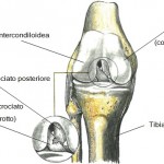 rottura-legamento-crociato-anteriore