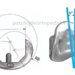 Disegno protesico della componente femorale