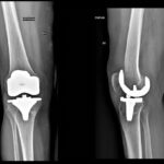 Radiografia di un ginocchio protesizzato con protesi a pivot mediale